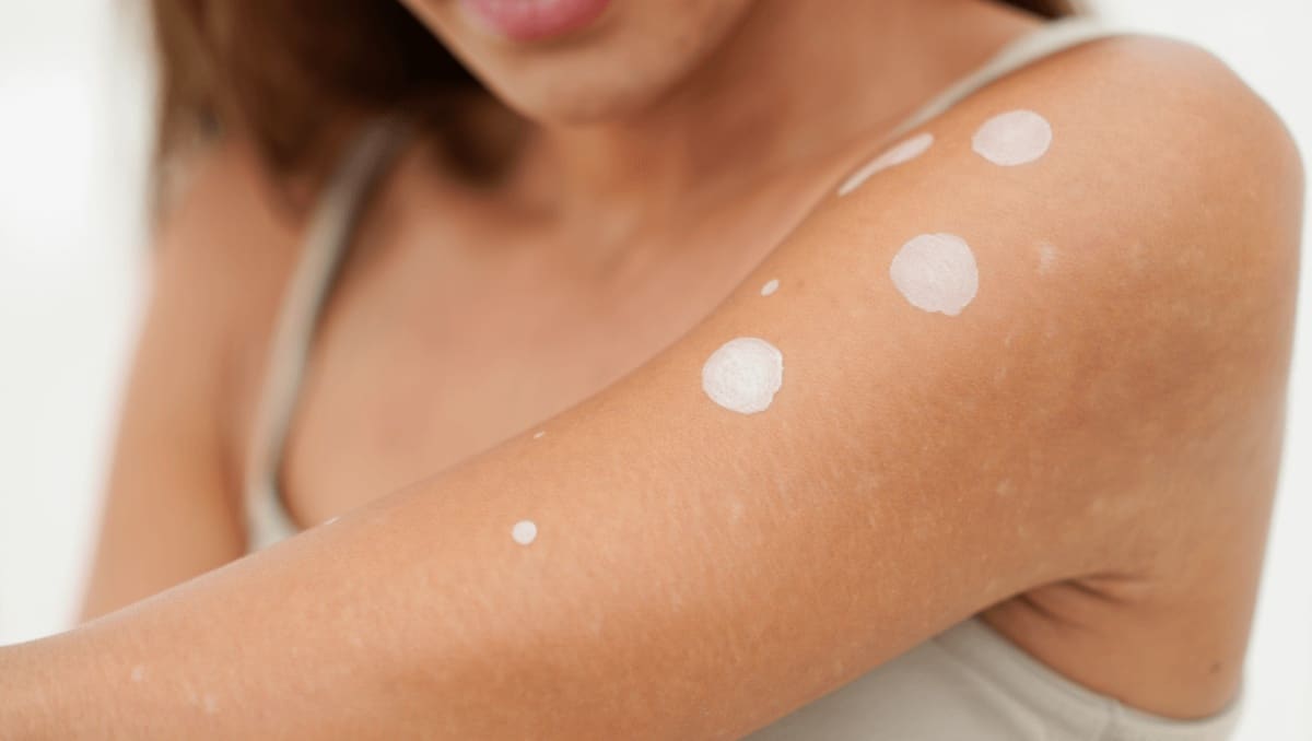 Avez-vous déjà remarqué de petites taches blanches sur vos bras ou vos jambes ? Ce que dit un dermatologue va vous rassurer