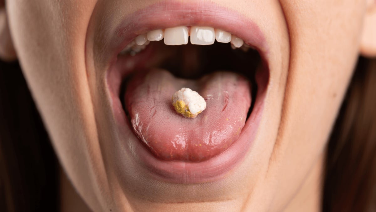 Pourquoi certaines personnes expulsent-elles de petites boules malodorantes de leur gorge ? 