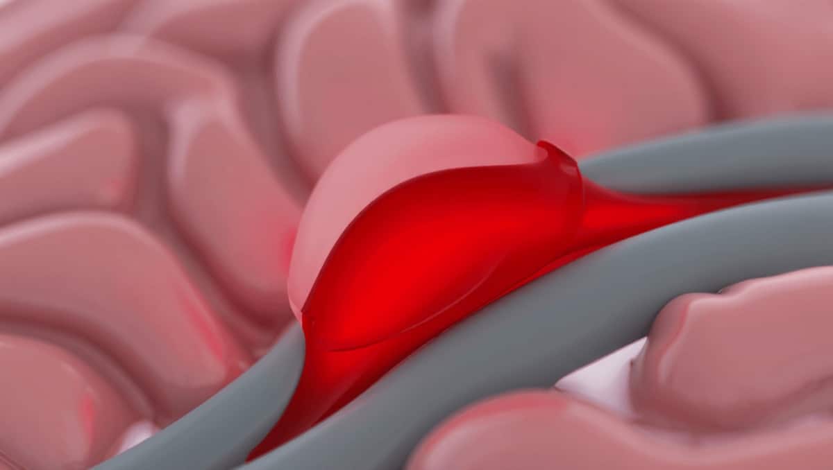 Rupture d’anévrisme : 7 signes que votre corps vous envoie qu’il ne faut surtout pas ignorer