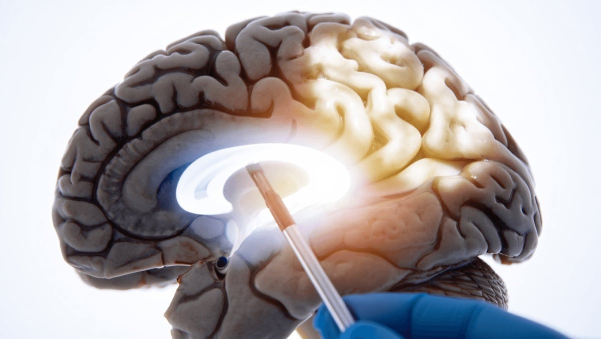 Alzheimer : des chercheurs découvrent comment la maladie se propage dans le cerveau, et comment l