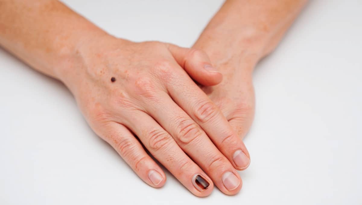 These Overlooked Skin Cancer Signs Could Be Easy to Miss